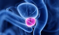 Cancer de la prostate : l’efficacité du traitement par ultrasons