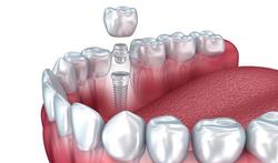 Implant dentaire : pourquoi il faut arrêter de fumer