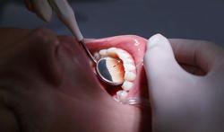 Antibioticarichtlijn voor tandartsen moet aantal onnodige voorschriften inperken