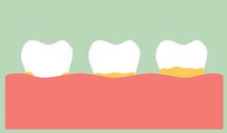 Veroorzaakt tandvleesbacterie ook reuma?