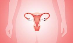 Endometriose: 'Menstruatiepijn bij jonge meisjes is niet normaal.'