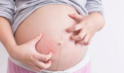 Heb je last van zwangerschapsjeuk?