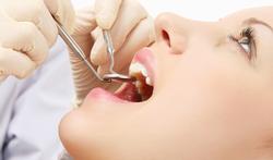 Gingivite et parodontite : causes, symptômes et traitement