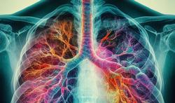 Pneumonie : causes, symptômes et traitement