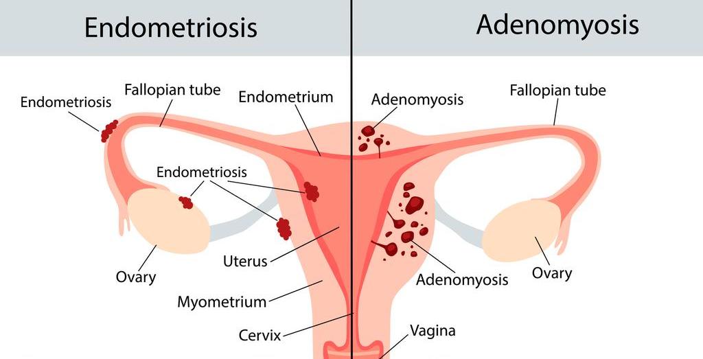 GettyI_adenomyose_endometriose_2024.jpg