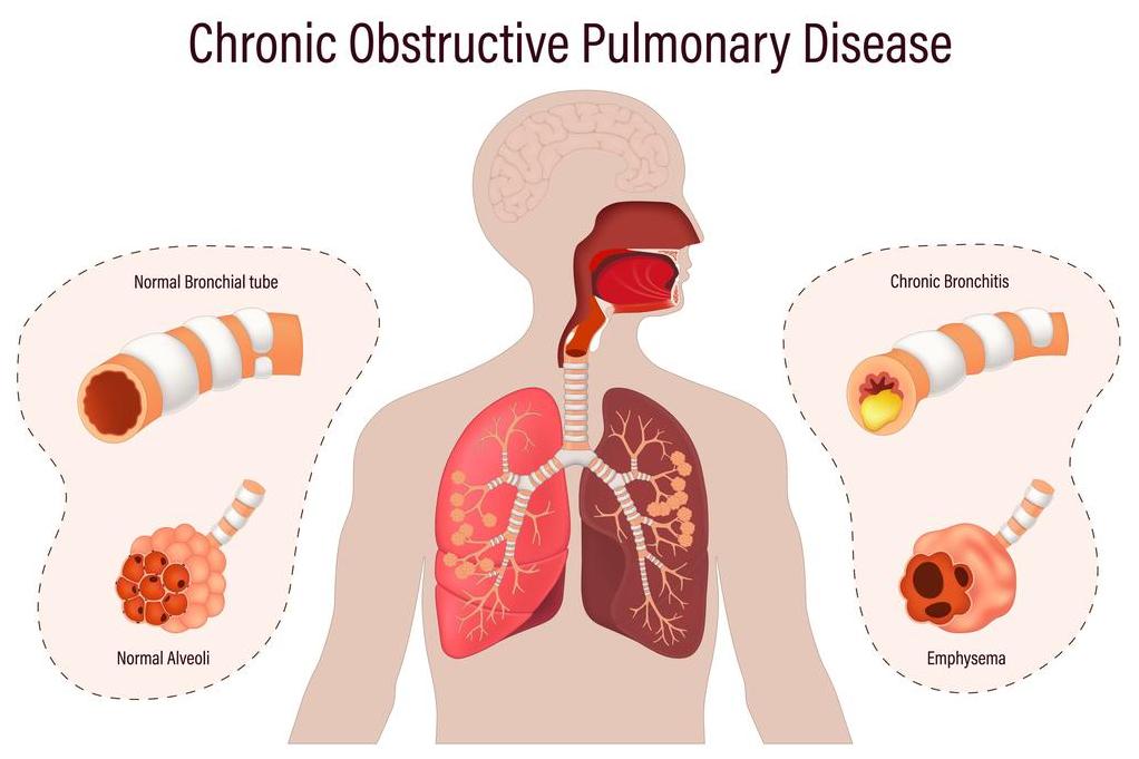Getty_BPCO_COPD_emphysem_bronchit_big_2026.jpg