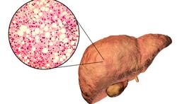 NASH ou NAFLD : c’est quoi la maladie du foie gras ? 