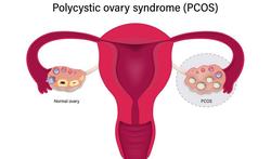 PCOS: Een belangrijke oorzaak van verminderde vruchtbaarheid