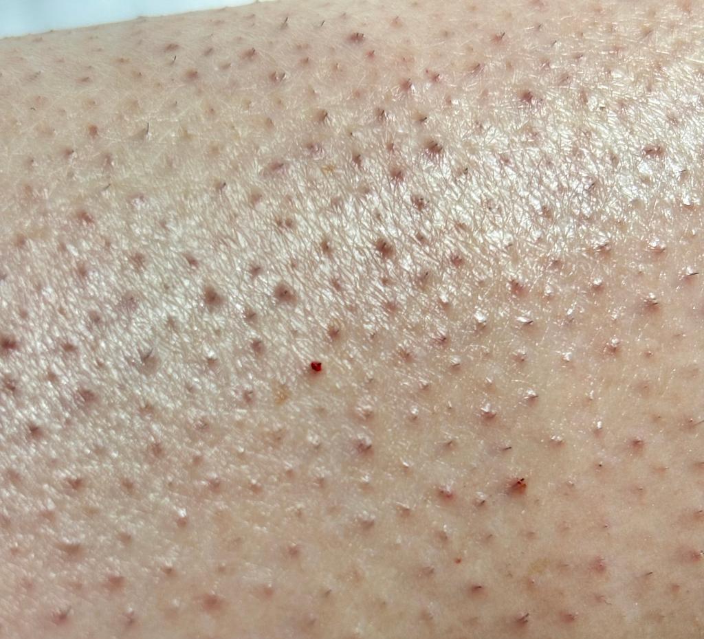 Getty_aardbeihuid_keratosispilaris_2025.jpg