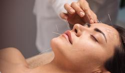 Wat zijn de voordelen van acupunctuur voor je gezondheid?