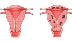 Endometriose: symptomen adenomyose