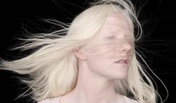 Albinisme bij mensen: types en symptomen