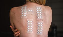 Allergietest: welke testen bestaan in België?