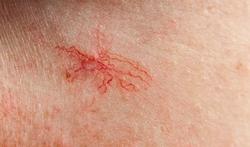 Vaisseau sanguin éclaté sous la peau : causes et que faire ?