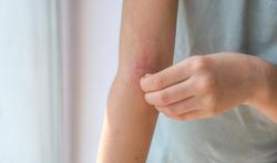 Eczeem bij baby en kind: symptomen en behandeling