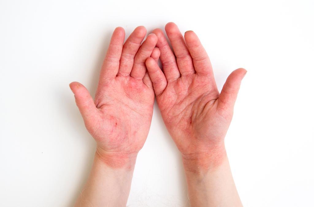 © Getty Images / atopische dermatitis of eczeem op handen Getty_atopischedermatitis_eczeem_2025.jpg