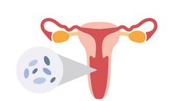 Bacteriële vaginose: symptomen en behandeling
