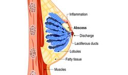 Abcès du sein : causes, symptômes et traitement