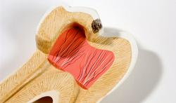 Quels sont les symptômes de la carie ? 