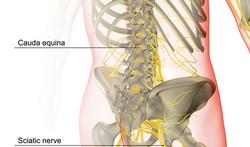 Cauda-equinasyndroom: rugpijn die snel invaliditeit veroorzaakt