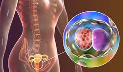 Cervicitis: ontsteking van de baarmoederhals