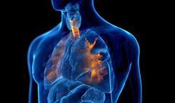 COPD of 'rokerslong': chronische en langzaam progressieve longaandoening