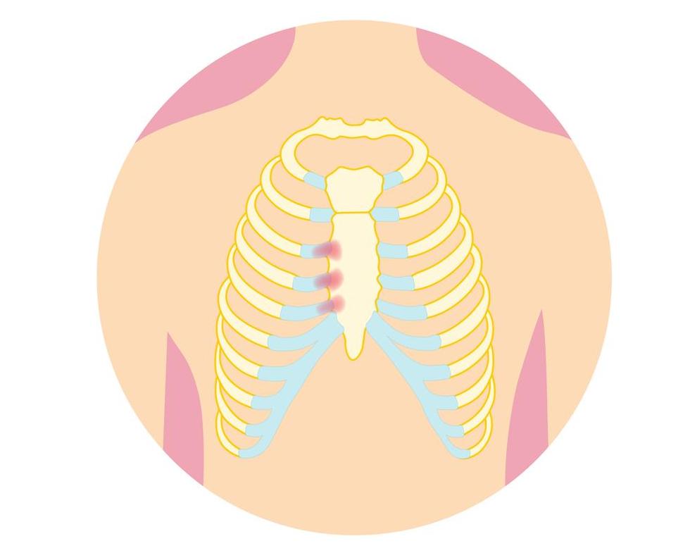 Getty_costochondritis_2025.jpg