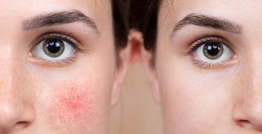 © Getty Images - Couperose, une dilatation permanente des petits vaisseaux sanguins du visage Getty_couperose_2025.jpg