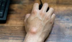Knobbel op hand, pols of voet: wat is een cyste of ganglion?