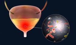 Blaasontsteking (cystitis): symptomen, oorzaken en behandeling
