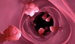 'Darmkanker vroegtijdig opsporen via een eenvoudige bloedtest'