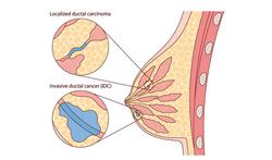 Ductaal carcinoom in situ (DCIS): vroege vorm van borstkanker