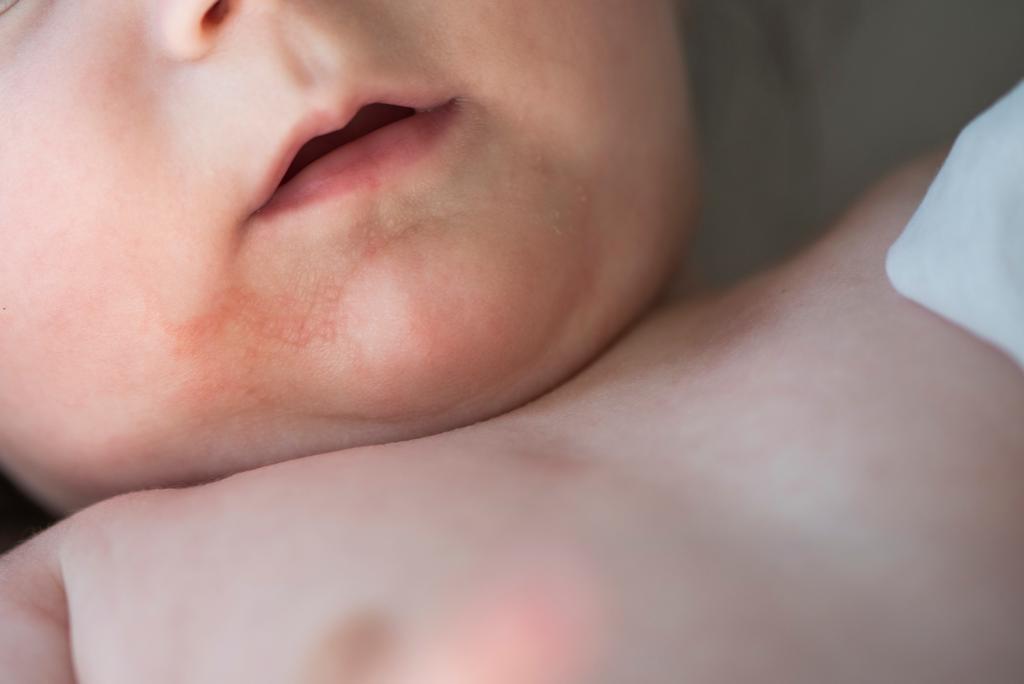 © Getty Images / eczeem op het gezicht van baby Getty_eczeem_baby_2025.jpg