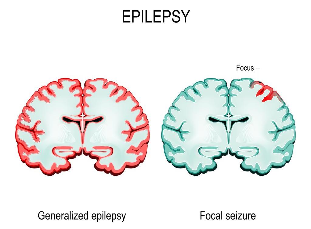 Getty_epilepsie_soorten_2025.jpg