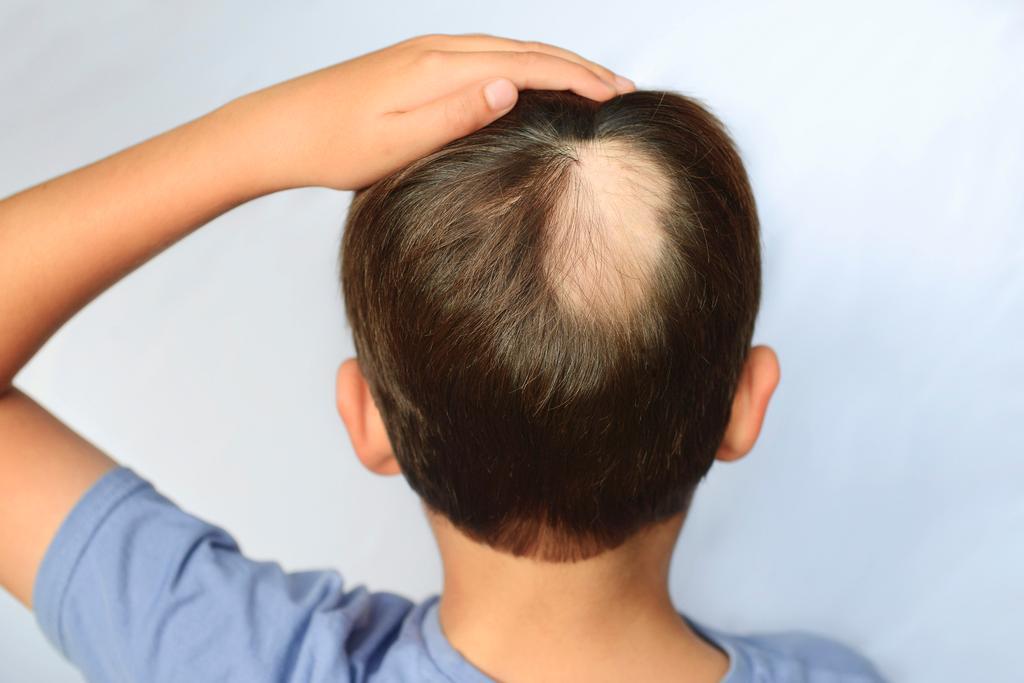 © Getty Images / Hair pulling disorder (trichotillomanie): dwangmatig haar uittrekken Getty_haaruitval_kaal_trichotillomanie_2025.jpg