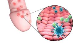 Herpes genitalis: erg besmettelijke soa