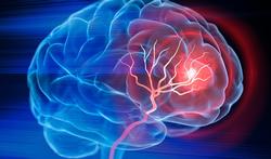 Hersenbloeding: oorzaak, symptomen en behandeling