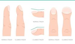 Hippocratisme digital : que révèle vraiment ce test des ongles sur le cancer du poumon ?