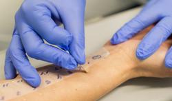 Hoe werkt een huidtest voor allergie?