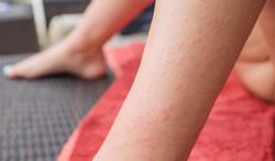 Dermatitis herpetiformis of 'coeliakie van de huid': huidaandoening door glutenintolerantie