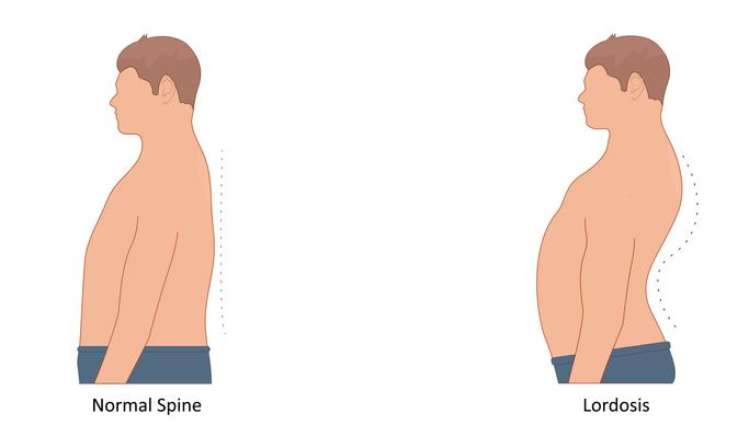 Getty_hyperlordose_lordosis_2025.jpg