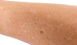 Hypomélanose en gouttes : taches blanches sur la peau causées par le soleil