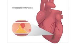 Infarctus du myocarde : que se passe-t-il pendant une crise cardiaque et après ?