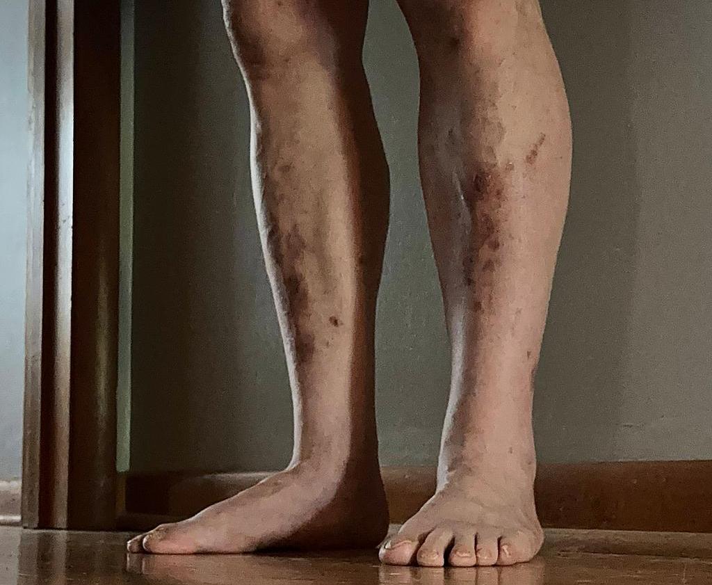 © Getty Images - Dermopathie diabétique, taches rouges ou brunes sur les tibias Getty_jambes_diabete_benen_2025.jpg
