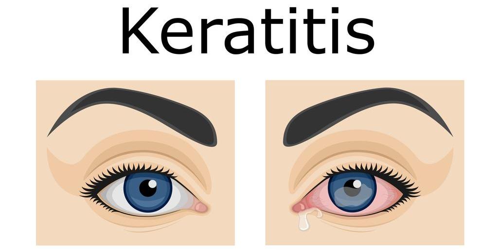 Getty_keratitis_oogontsteking_2025.jpg