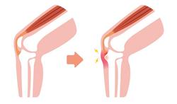 Osgood-Schlatter: kniepijn bij kind