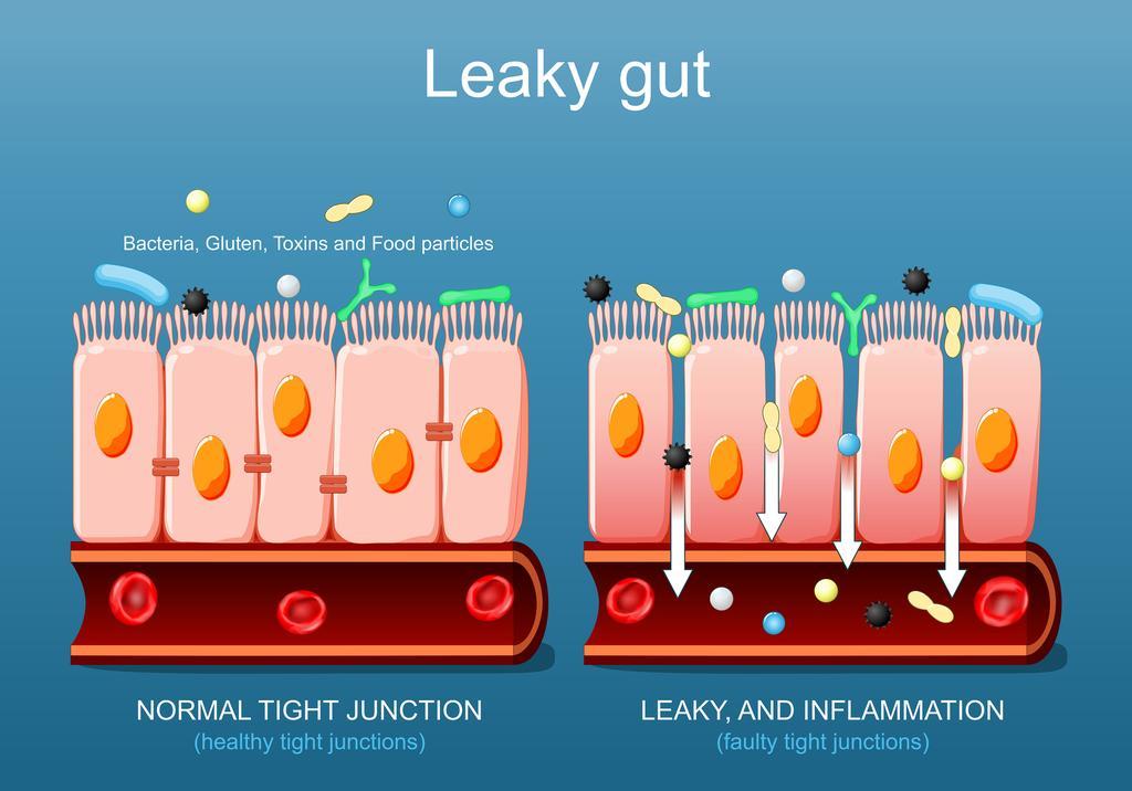 Getty_leakygut_lekkendedarm_2025.jpg