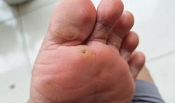 Cor au pied ou verrue : comment faire la différence (photos)