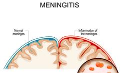 Quels sont les symptômes d’une méningite bactérienne et d’une méningite virale?