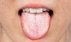 Muguet buccal chez l’adulte : symptômes et traitement